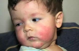 娱乐吃瓜酱过敏,吃瓜酱过敏背后的惊人真相